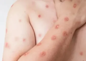 Casos de Mpox mais que dobram em 20 dias no Brasil; veja regiões afetadas